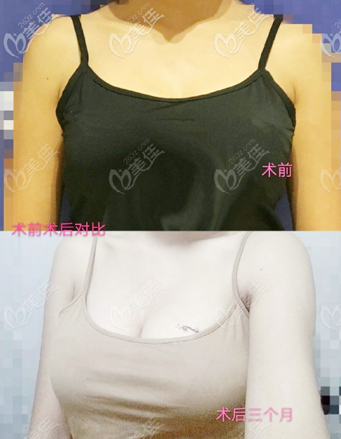 北京<!--<i data=20240703-sp></i>--><!--<i data=20240703-sp></i>-->隆胸图片