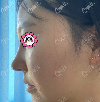 找薛轶群做鼻子有10几天了