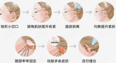 面部筋膜提升手术过程示意图 面部筋膜提升手术过程示意图