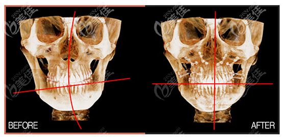 周会喜正颌手术ct对比图