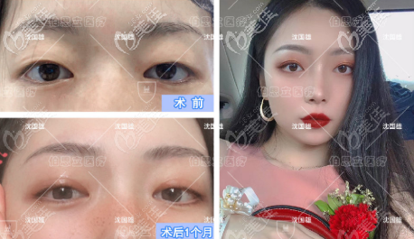 沈国雄全切双眼皮+双侧提肌矫正效果图