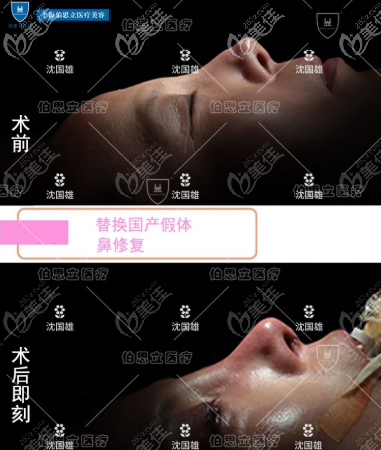 百达丽&伯思立整形沈国雄挛缩鼻凹陷修复效果图