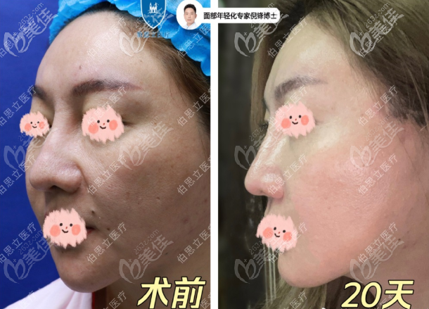 倪锋面部小拉皮提升+面部吸脂+5G黄金微雕20天效果图