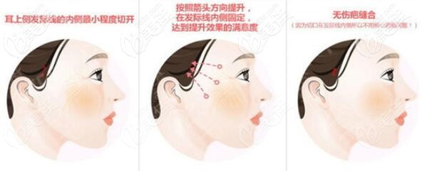 日式迷你小拉皮手术操作过程示意图 日式迷你小拉皮手术操作过程示意图