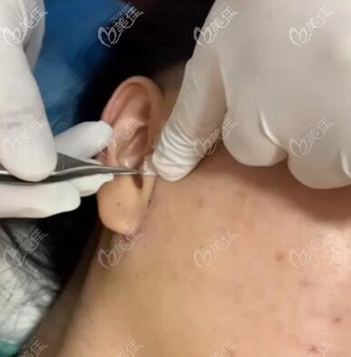 小拉皮手术切口位置展示 小拉皮手术切口位置展示