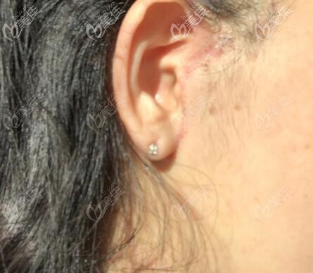 小切口拉皮手术恢复25天疤痕图片 小切口拉皮手术恢复25天疤痕图片