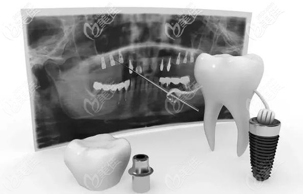 半口种植牙的手术过程