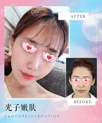 荟光子嫩肤真人前后对比照 荟光子嫩肤真人前后对比照