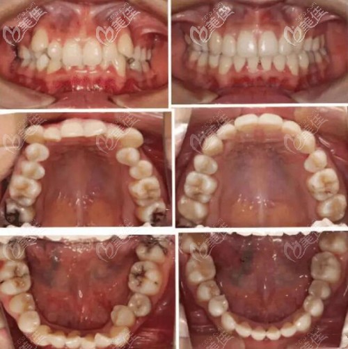 深覆合矫正前后对比