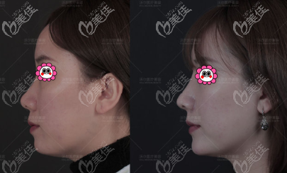 冯雁平鼻综合案例效果参考