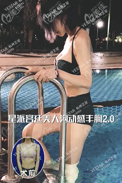 杭州艺星医院万连壮假体隆胸案例 杭州艺星医院万连壮假体隆胸案例