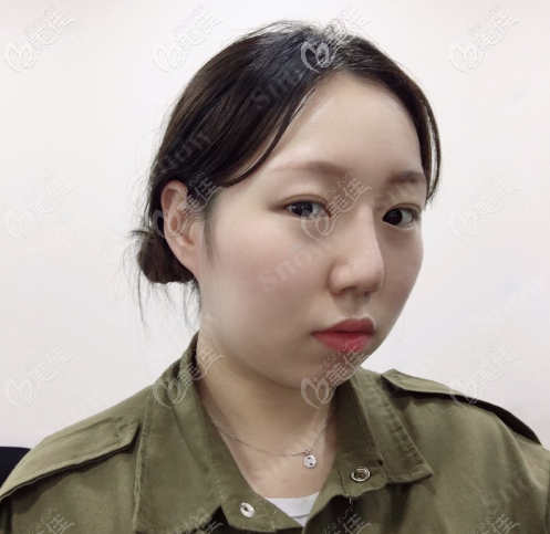 韩国snow面部吸脂+填充案例术前照 韩国snow面部吸脂+填充案例术前照