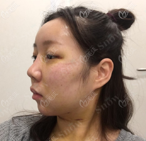 韩国snow面部吸脂+填充案例术后第六天 韩国snow面部吸脂+填充案例术后第六天