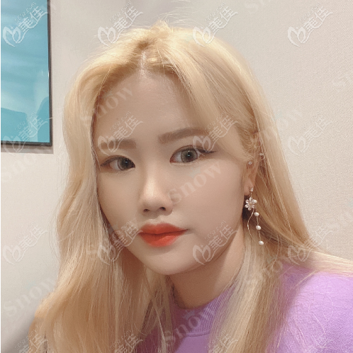 韩国snow面部吸脂真人案例术前照 韩国snow面部吸脂真人案例术前照