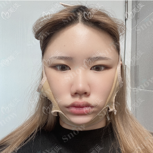 韩国snow面部吸脂真人案例术后第七天 韩国snow面部吸脂真人案例术后第七天