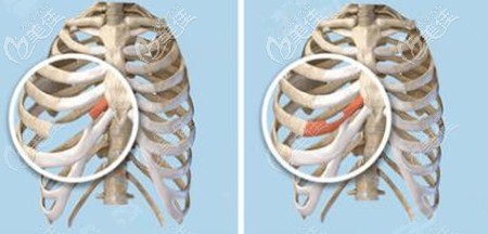 仇侃敏做肋骨鼻子的优势