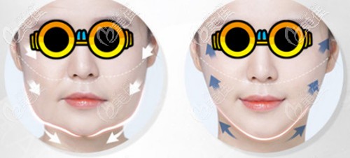 中下面部提升术包括的部位图解