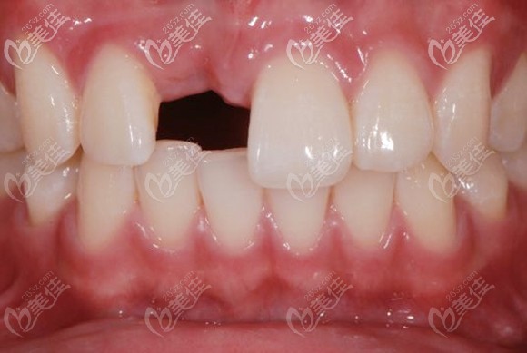 上排右门牙缺失图 上排右门牙缺失图
