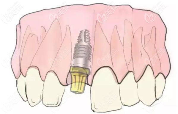 门牙植入种植体和基台的效果 门牙植入种植体和基台的效果