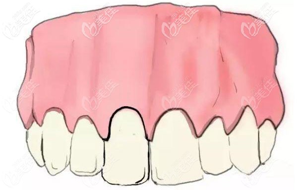 门牙美学修复后图片 门牙美学修复后图片