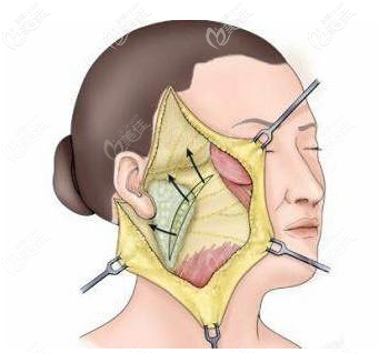 风筝小切口拉皮优势