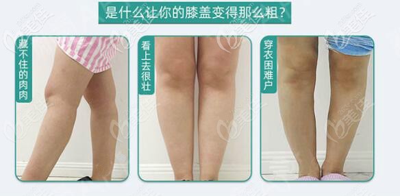 膝盖抽脂可以单独做吗 膝盖抽脂可以单独做吗