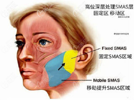 聂云飞医生拉皮手术做的好的优势点三 聂云飞医生拉皮手术做的好的优势点三