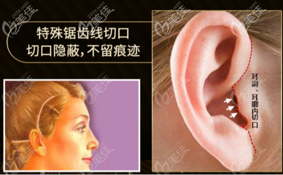 聂云飞医生拉皮手术做的好的优势点四 聂云飞医生拉皮手术做的好的优势点四