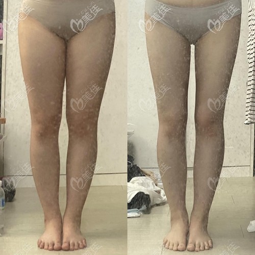 无限兰斯吸脂瘦大腿前后对比
