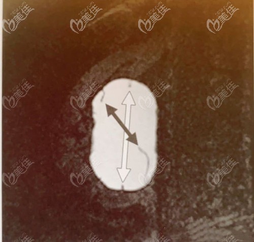 乳腺核磁下的假体褶皱