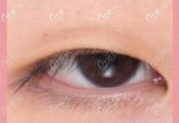 眼型不好看怎么改善