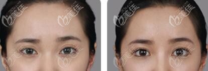 朴章佑院长双重固定法眼型矫正术真人前后对比照