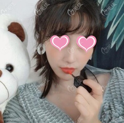 快翎线提升术后1个月效果