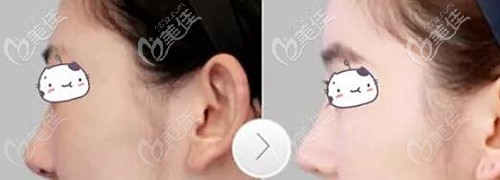 仇侃敏医生隆鼻案例