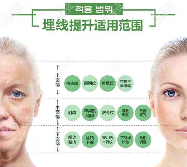埋线提升使用范围 埋线提升使用范围