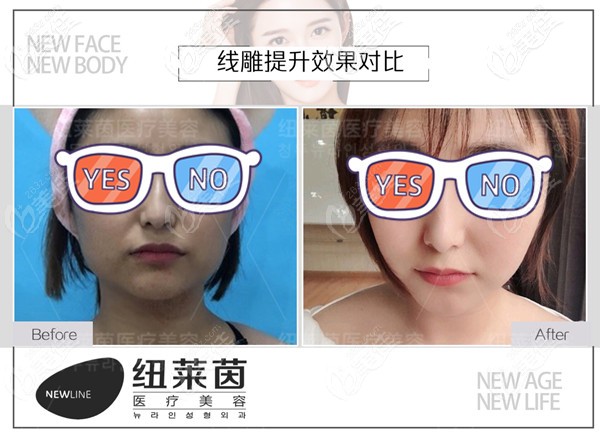 <!--<i data=20240703-sp></i>-->埋线提升案例效果图 <!--<i data=20240703-sp></i>-->埋线提升案例效果图