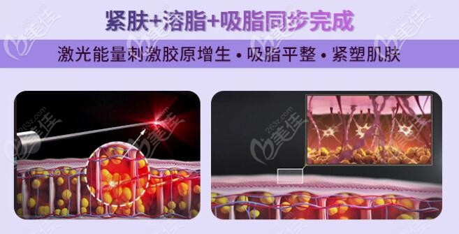 天使光雕吸脂效果