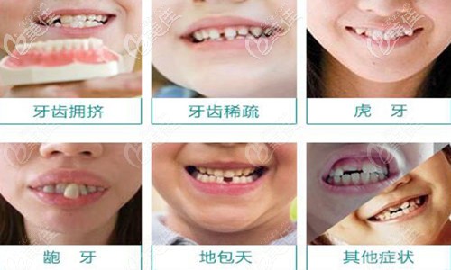 牙齿畸形图