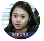 做5G天使光雕面部吸脂前 做5G天使光雕面部吸脂前