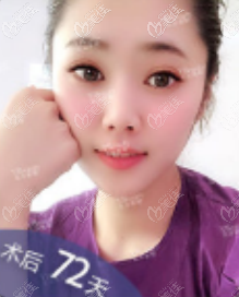 北京雅靓吸脂怎么样?我做5g天使光雕面部吸脂案例效果参考 北京雅靓吸脂怎么样?我做5g天使光雕面部吸脂案例效果参考