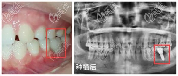 安排上东莞恒好口腔种植下磨牙的真实案例,看看效果怎么样吧