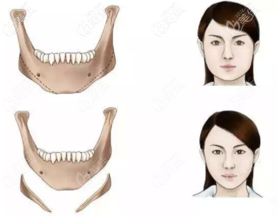 长曲线下颌角费用