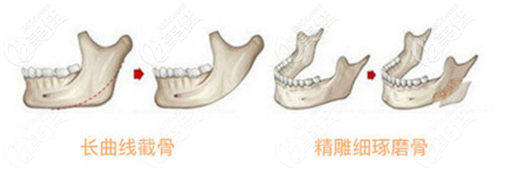 长曲线下颌角截骨对比图