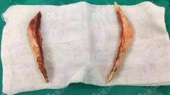 长曲线下颌角截骨手术截骨图片