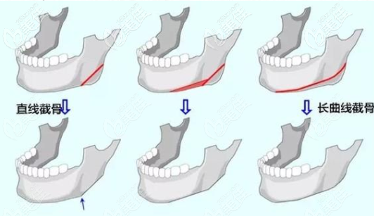 长曲线下颌角截骨