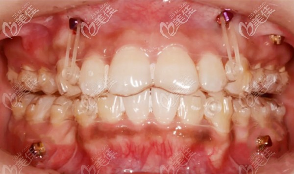 隐形牙套推磨牙后移的病例