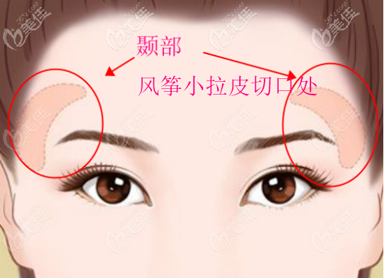 风筝小拉皮手术的切口