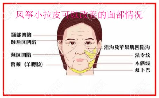 风筝小拉皮手术可以改善的面部问题