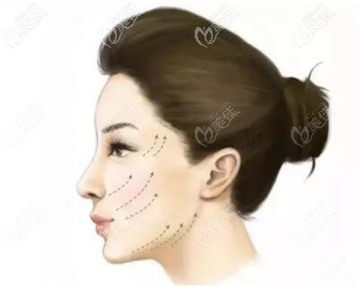 大连达美元辰医疗美容做埋线提升效果怎么样