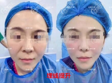 大连达美元辰医疗美容做埋线提升真人前后对比照